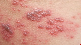 慢性腎病病人的帶狀疱疹風險與預防