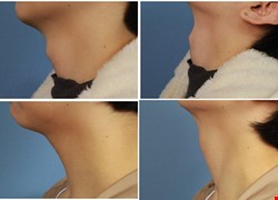 喉結手術、無疤痕喉結減積手術 （Scarless Thyroid Cartilage Reduction）