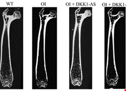 Dickkopf-1 (DKK1) blockade mitigates osteogenesis imperfecta (OI) related bone disease
